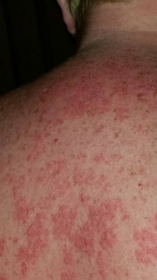 Coping With Itchy Rashes Lupus Uk